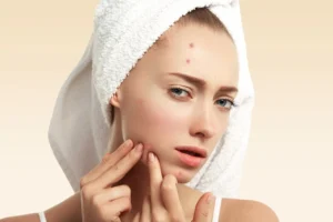 10 Simple DIY Skin Hacks for Overnight Acne Relief!