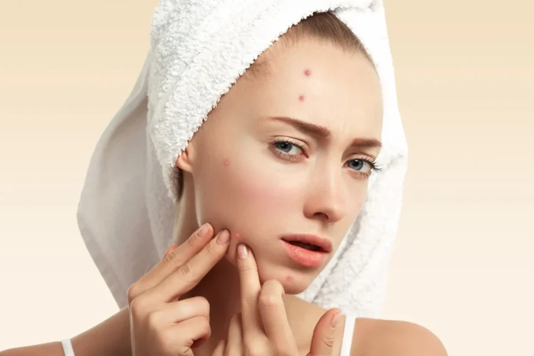 10 Simple DIY Skin Hacks for Overnight Acne Relief!